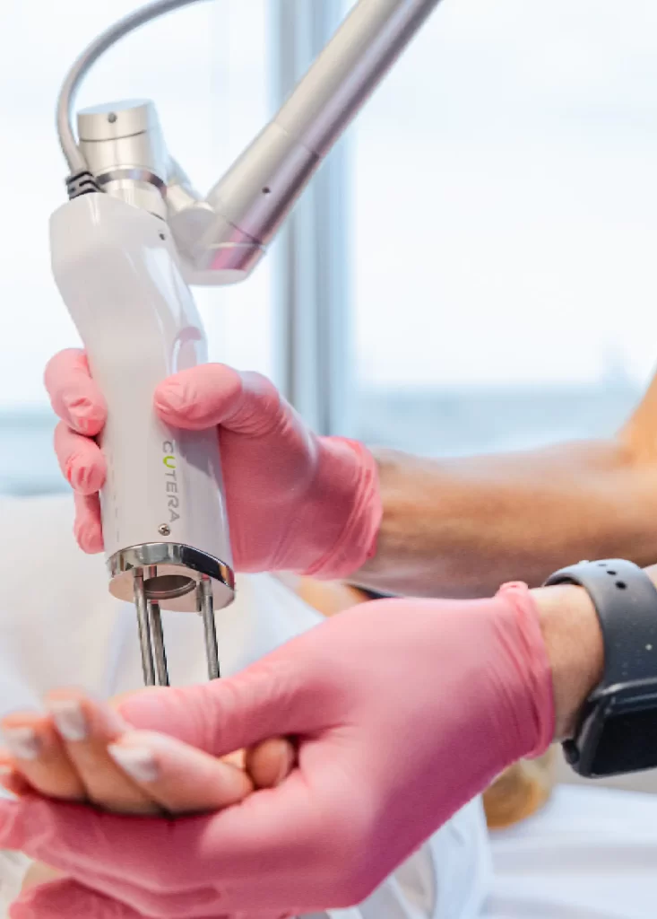 Specialist performing laser treatment on a patient’s hand using advanced Cutera laser device at Emara Skin Clinic
