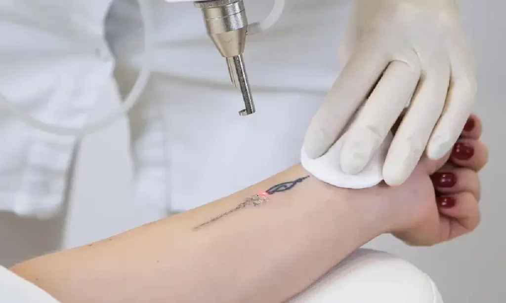 Laser tattoo removal procedure on a small wrist tattoo at Emara Skin Clinic