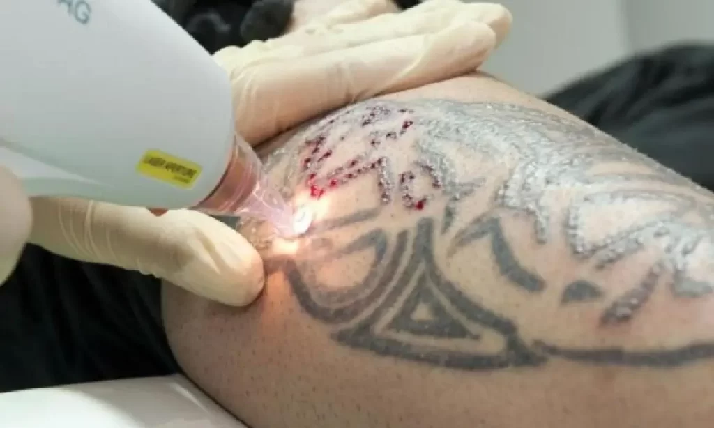 Laser tattoo removal treatment on a large arm tattoo using advanced Q-switched technology at Emara Skin Clinic"