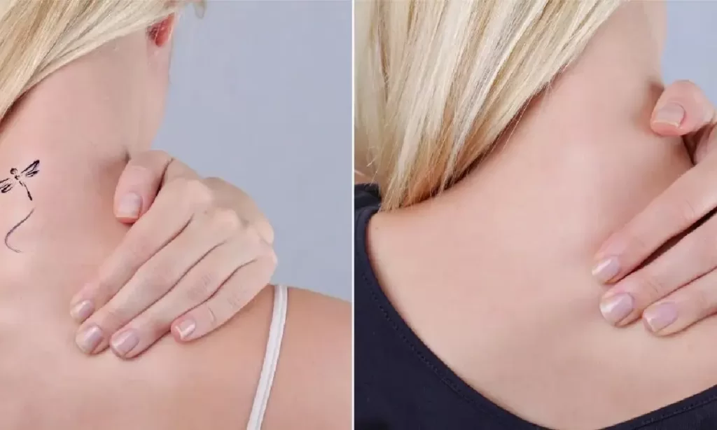 Before and after laser tattoo removal on the neck showing complete removal of a small tattoo at Emara Skin Clinic