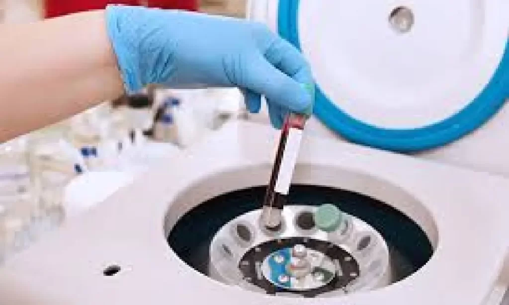 Blood sample being placed into a centrifuge machine for PRP preparation at Emara Skin Clinic