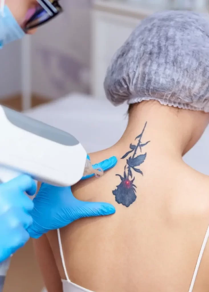 Laser tattoo removal treatment being performed on a floral neck tattoo at a dermatology clinic