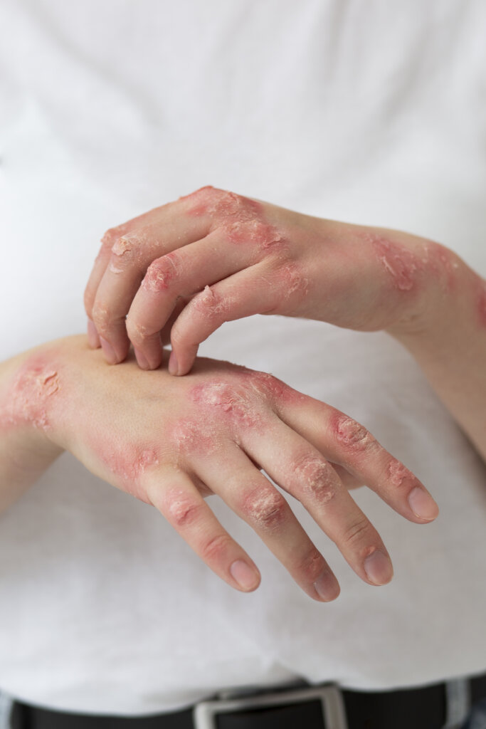 Hands with red, dry, and inflamed eczema patches – eczema treatment at Emara Skin Care
