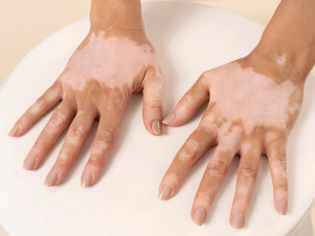 Melanocyte activation therapy for vitiligo to restore skin pigmentation