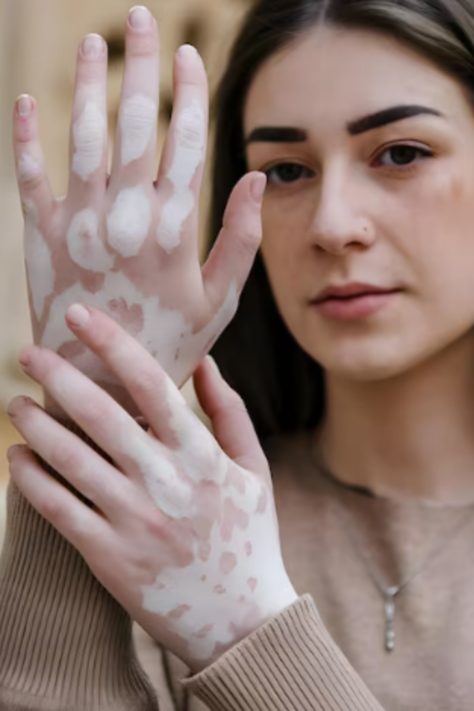 Vitiligo treatment improving white patches and restoring natural skin color