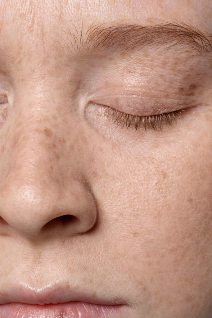 Melasma treatment showing reduction of dark pigmentation patches on face with clear and even skin tone