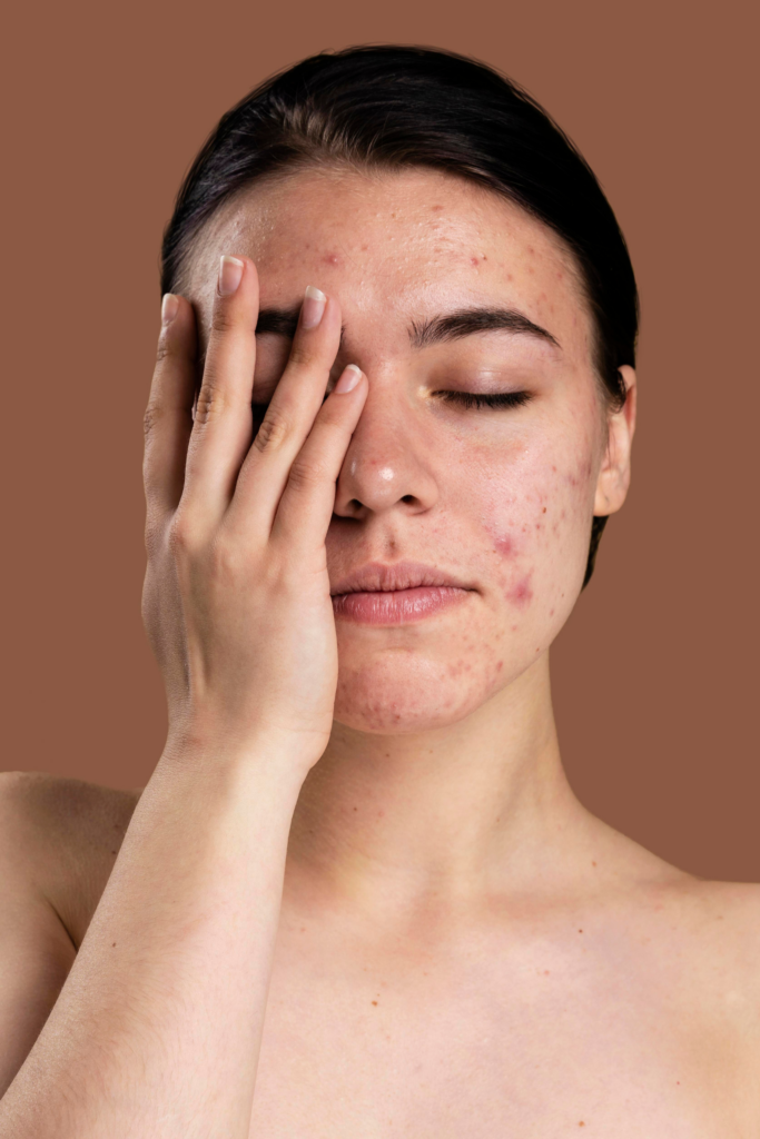 Melasma treatment showing reduction of dark pigmentation patches on face with clear and even skin tone
