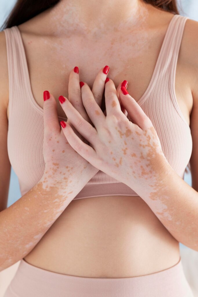 Vitiligo treatment improving white patches and restoring natural skin color