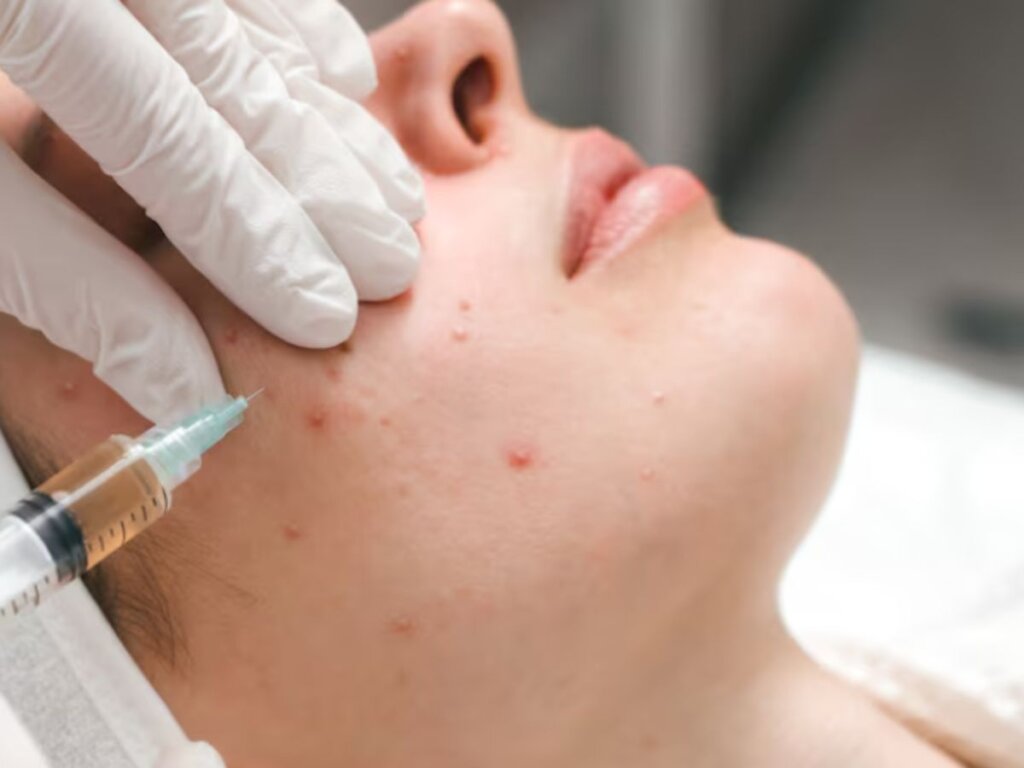 Medical acne treatment by dermatologist for safe and effective skin care