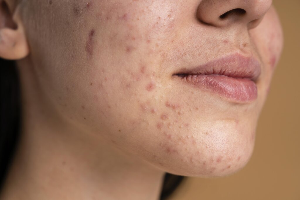 Acne scar treatment for smoother skin and reduced marks