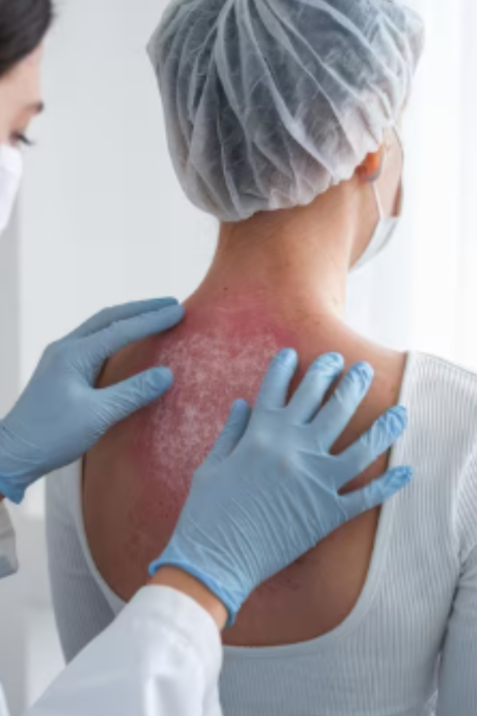 Psoriasis treatment in Delhi for red, scaly skin patches and inflammation
