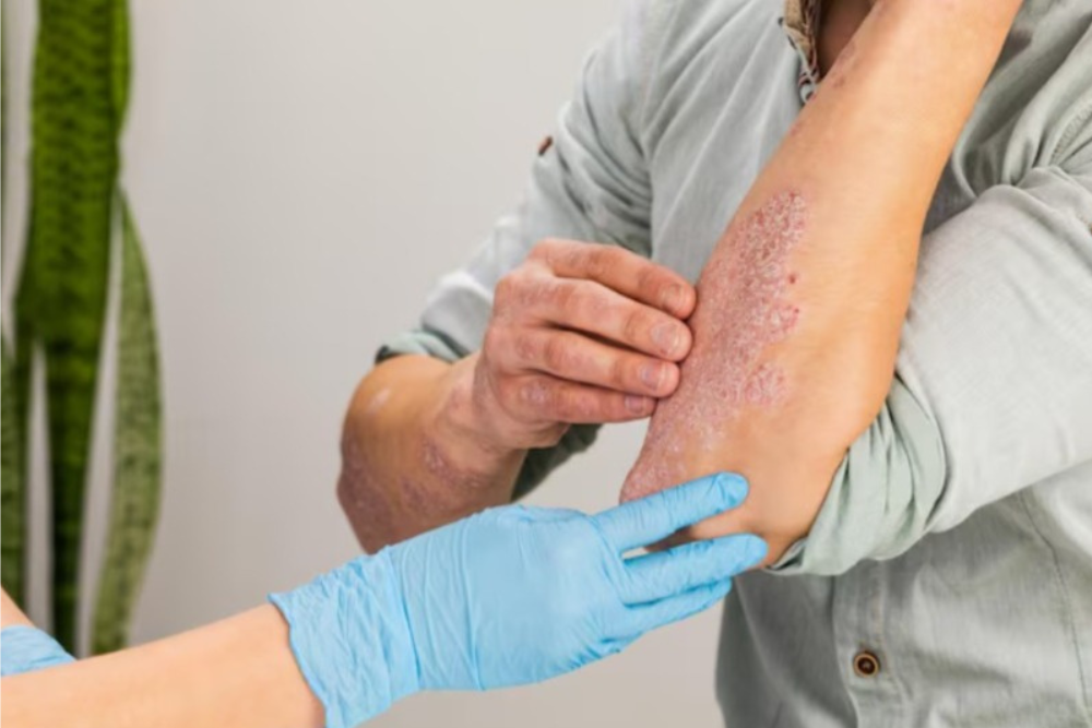 Plaque psoriasis with red raised patches and silvery scales on elbows and skin