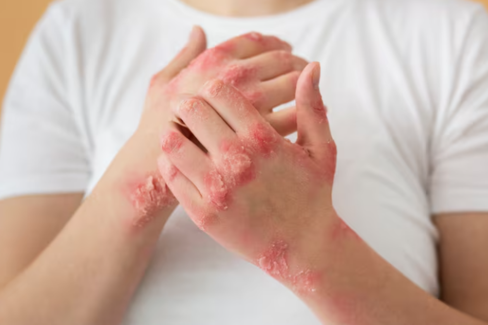 Guttate psoriasis with small red drop-shaped spots on the skin