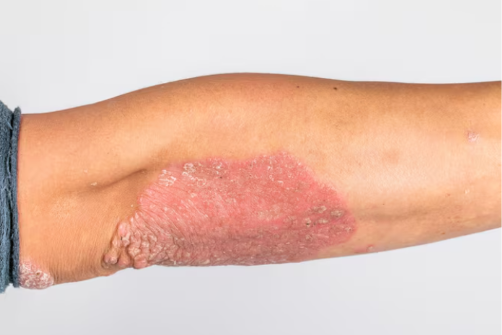 Inverse psoriasis with smooth red inflamed patches in skin folds