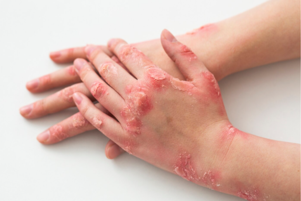 Pustular psoriasis with white pus-filled blisters on red inflamed skin