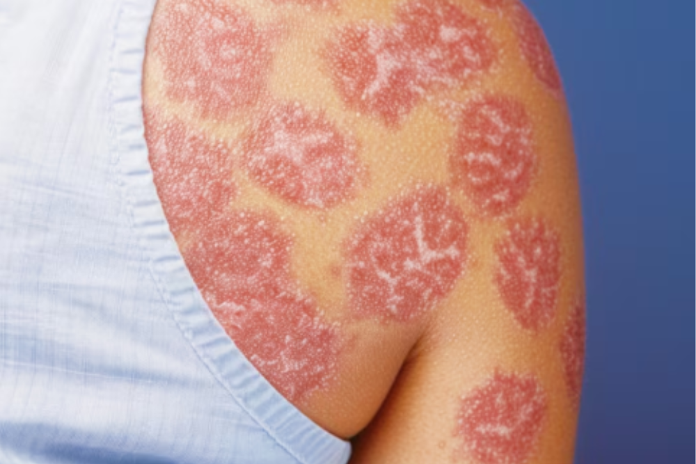 Erythrodermic psoriasis with widespread redness, peeling, and inflamed skin