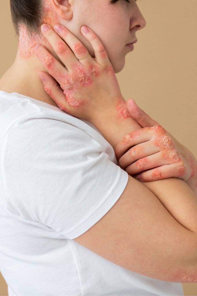 Psoriasis treatment in Delhi for red, scaly skin patches and inflammation