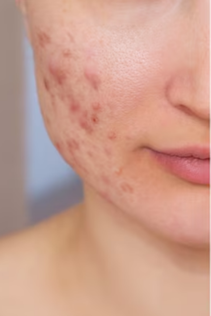 Facial Scars Treatment in Delhi | Smooth & Clear Skin