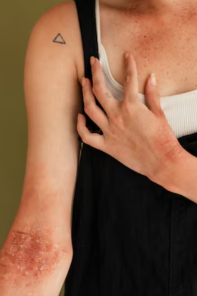 Dermatitis treatment and skin care consultation at emaraskinclinic by Dr. Mriganka Mehra