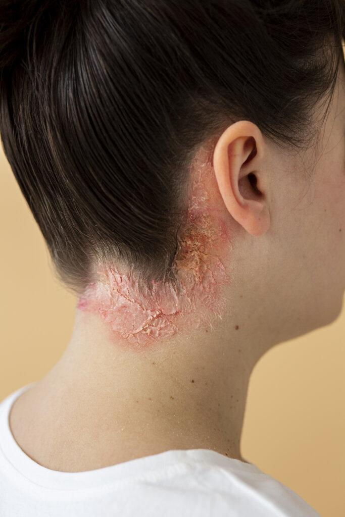 Psoriasis treatment in Delhi for red, scaly skin patches and inflammation