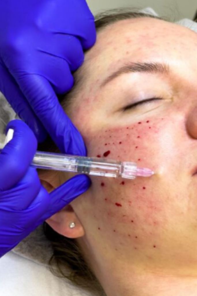 Dermapen 4 Treatment in Delhi for acne scars, pigmentation, and skin rejuvenation