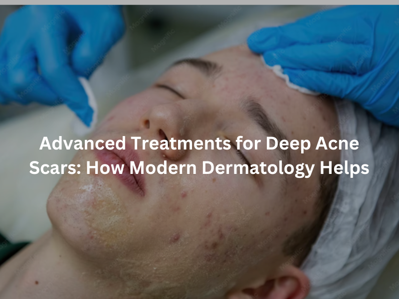 Advanced treatments for deep acne scars using modern dermatology procedures to improve skin texture and reduce scar appearance.