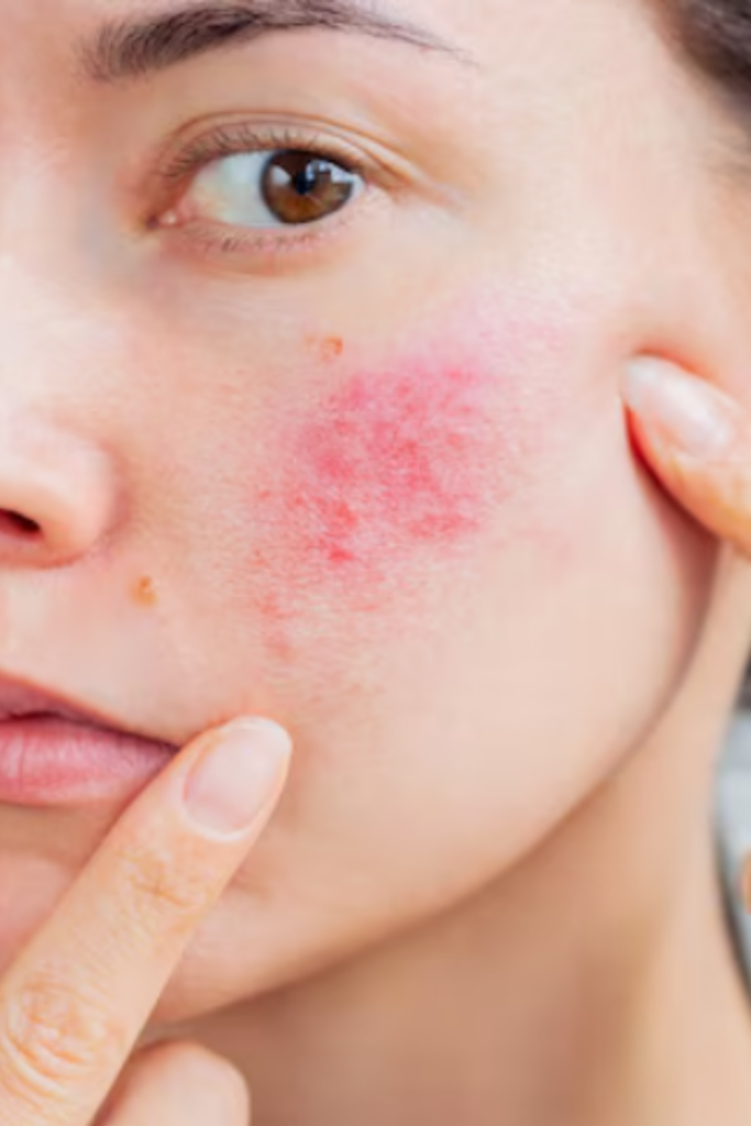 Sensitive Skin Treatment in Delhi by dermatologist for redness and skin irritation