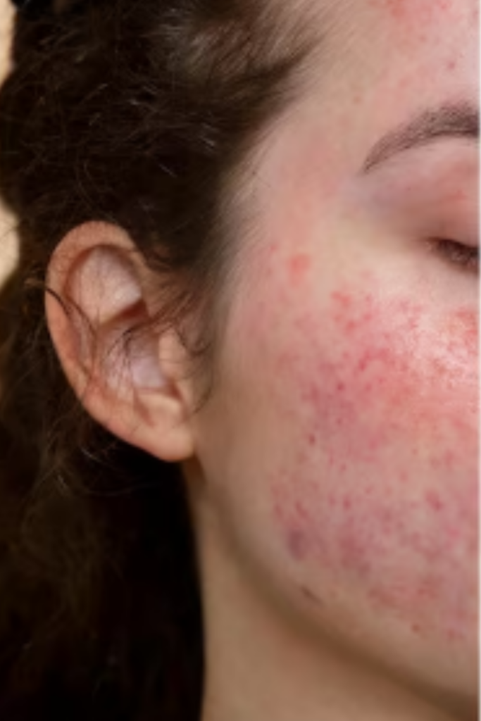 Acne Scar Treatment in Delhi to reduce acne scars and improve skin texture