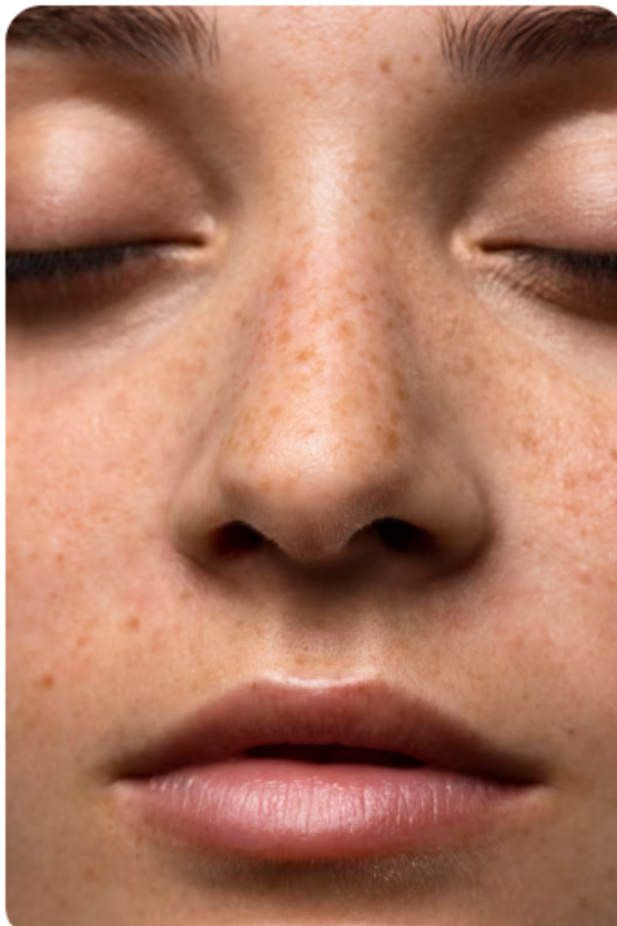 Hyperpigmentation Treatment in Delhi for dark spots and uneven skin tone