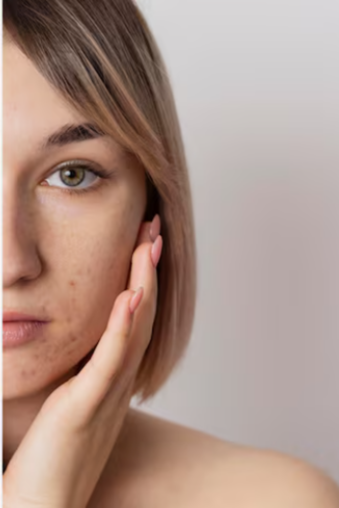 Laser freckles removal treatment on the face