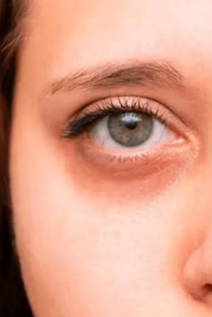 Dark Circles Treatment in Delhi to reduce under eye pigmentation and brighten tired eyes