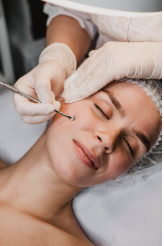 Acne Scar Treatment in Delhi to reduce acne scars and improve skin texture