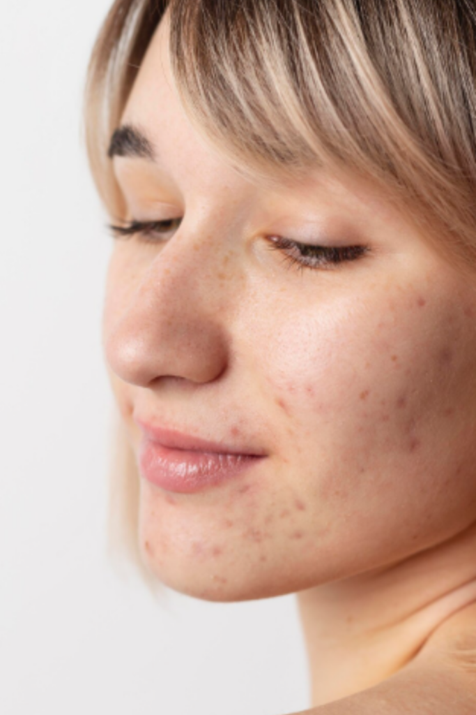 Acne Scar Treatment in Delhi to reduce acne scars and improve skin texture