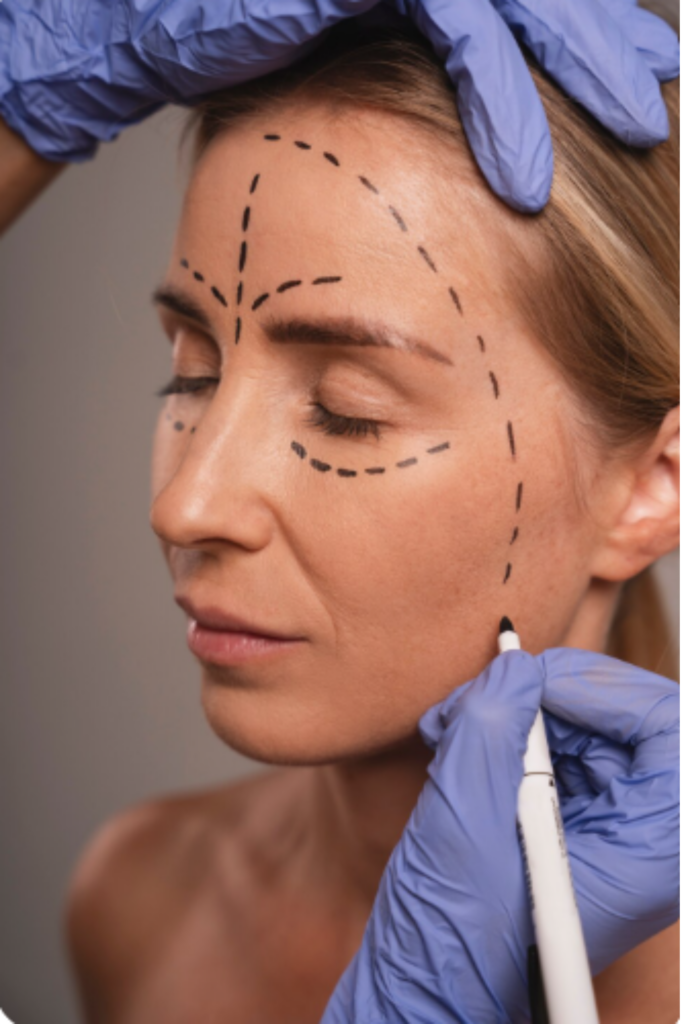 Thread Lift Treatment in Delhi | Emara Skin Clinic