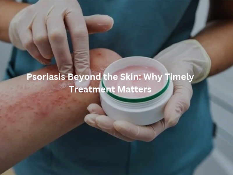 Psoriasis symptoms and timely psoriasis treatment