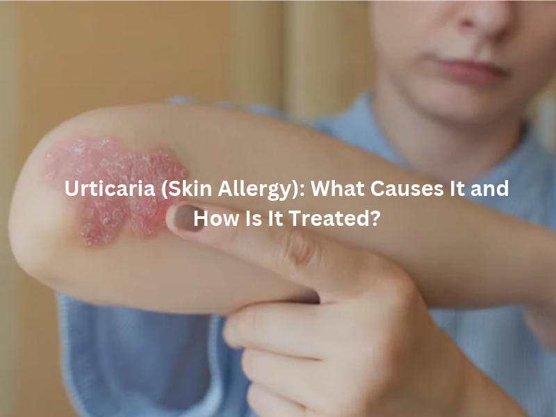 Urticaria causes and common skin allergy triggers